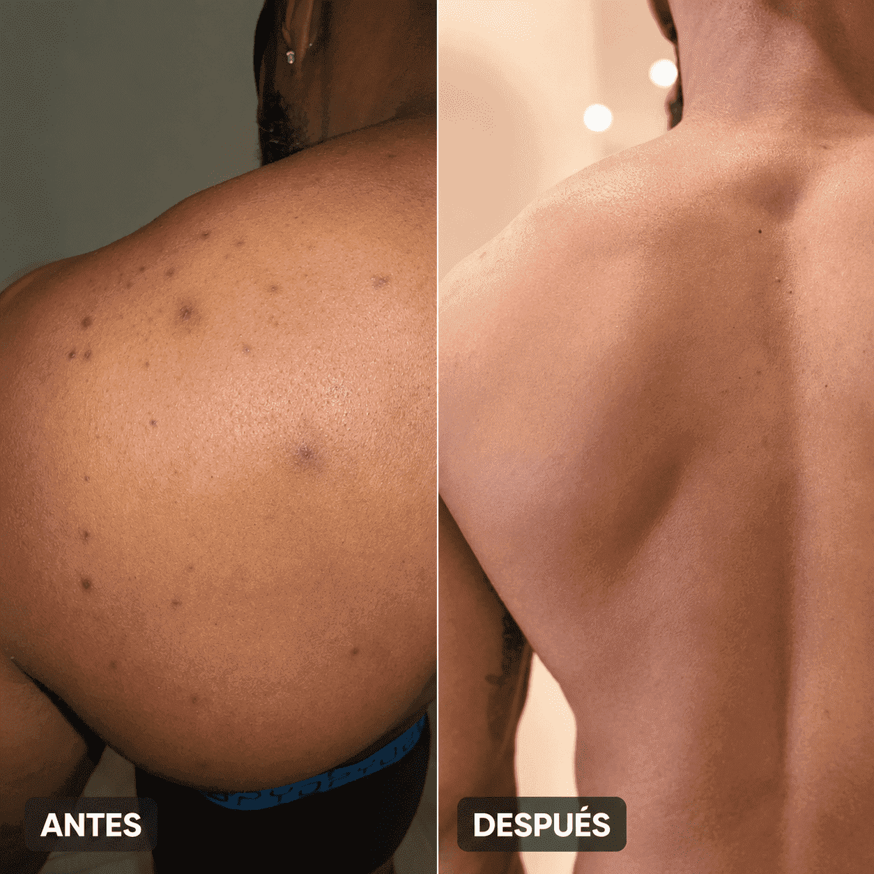 Body Acne | Decile chau al acné corporal en pocas semanas