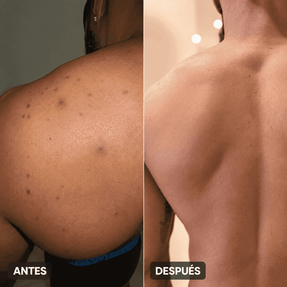 Body Acne | Decile chau al acné corporal en pocas semanas