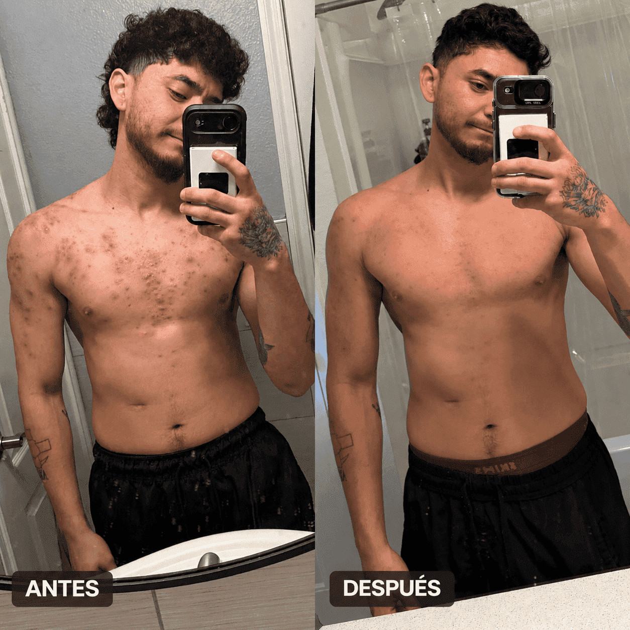 Body Acne | Decile chau al acné corporal en pocas semanas
