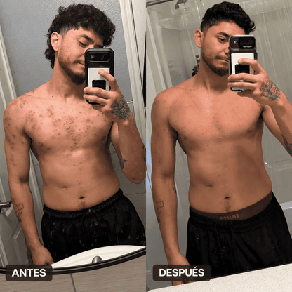 Body Acne | Decile chau al acné corporal en pocas semanas