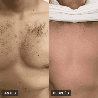 Body Acne | Decile chau al acné corporal en pocas semanas
